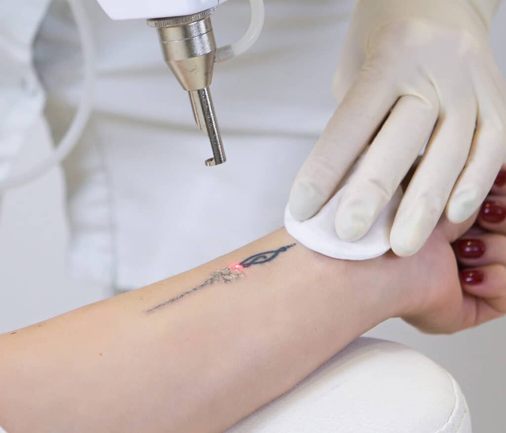 Détatouage au laser, retrait des tatouages, Vannes | Cabinet de Médecine Esthétique, Docteur Denis Mailliu