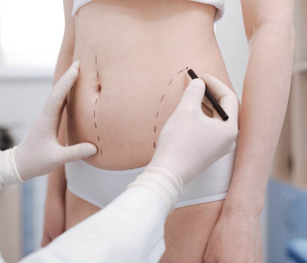 La Cryolipolyse Médicale, liposuccion par le froid | Cabinet de Médecine Esthétique à Vannes